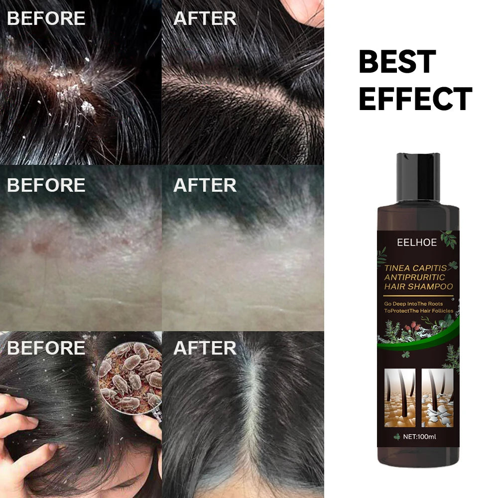 Anti dandruff Shampoo